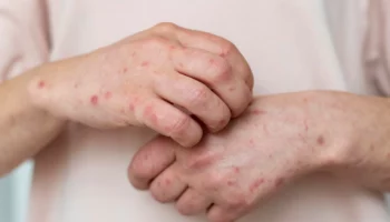 Корь: как защититься от опасного заболевания